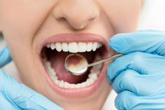 Dental Bonding Dental Bonding