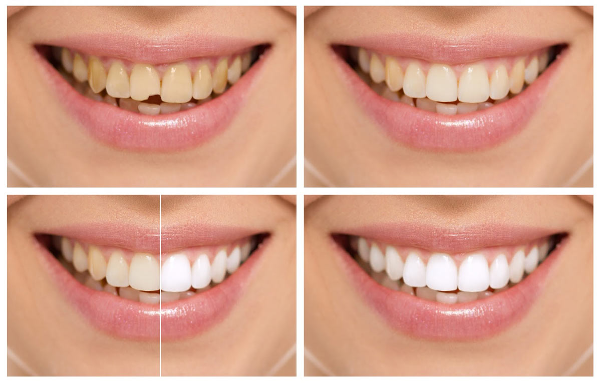 Dental Bonding Lahore
