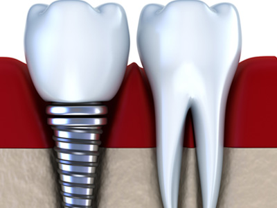 Dental Implants Lahore