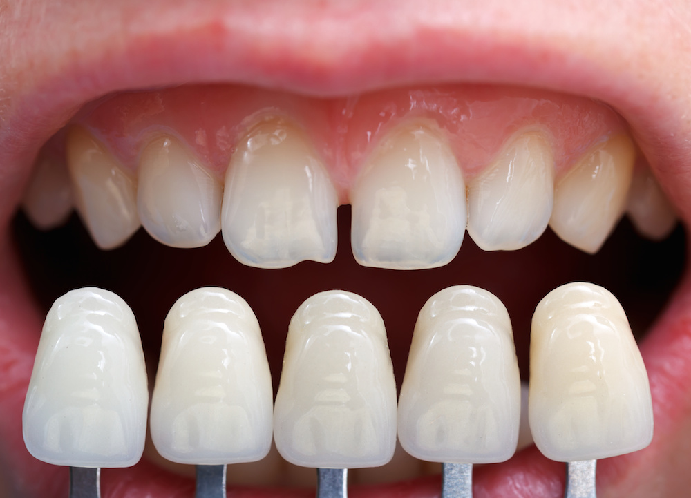 Dental Veneers Costs