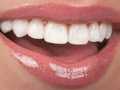 Veneers Lahore